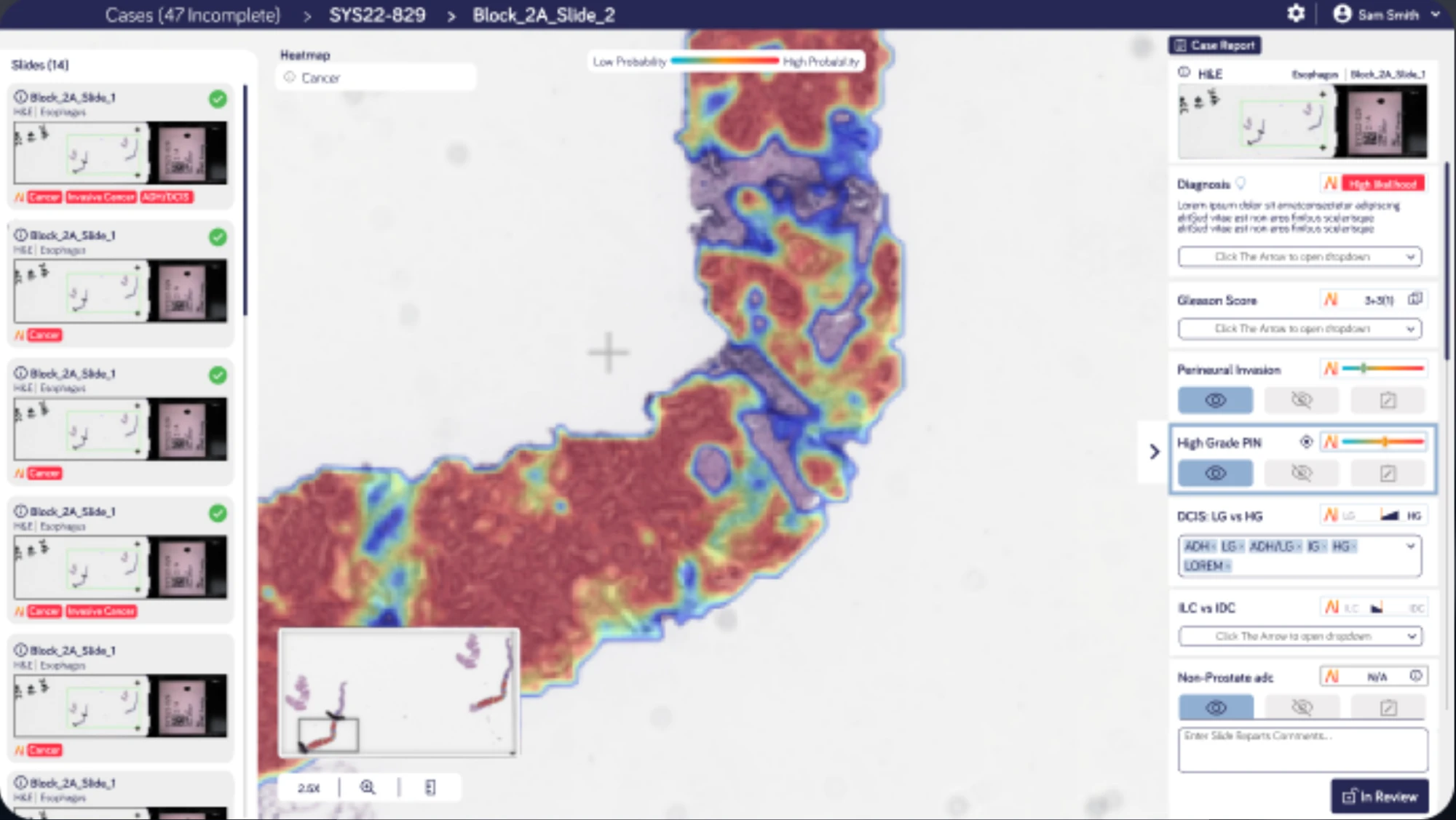 IBEX pathology viewer: slide list, a tissue sample with an AI cancer-probability heatmap, and a case report panel with AI findings
